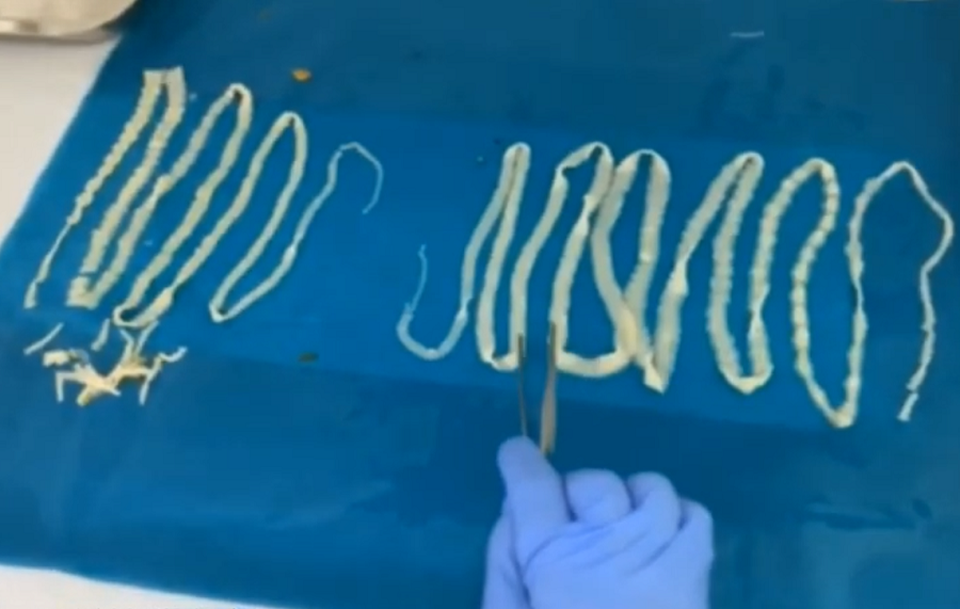 Cặp sán dây “khủng” trong cơ thể người đàn ông ngoại quốc - 2 Cặp sán dây “khủng” trong cơ thể người đàn ông ngoại quốc - 2