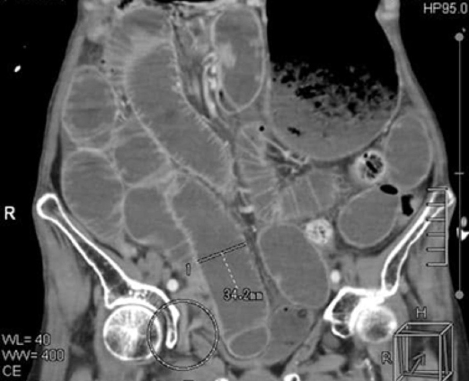 Trướng bụng, nôn ói ở người lớn tuổi coi chừng bệnh nguy hiểm - 1