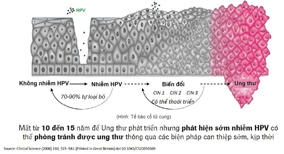 Dự phòng ung thư cổ tử cung bằng phác đồ sàng lọc bước đầu cho phụ nữ trên 25 tuổi - 2