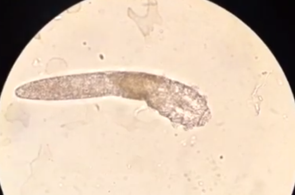 Ký sinh trùng đào hang khiến da mặt như bị mụn trứng cá - 2 Ký sinh trùng đào hang khiến da mặt như bị mụn trứng cá - 2