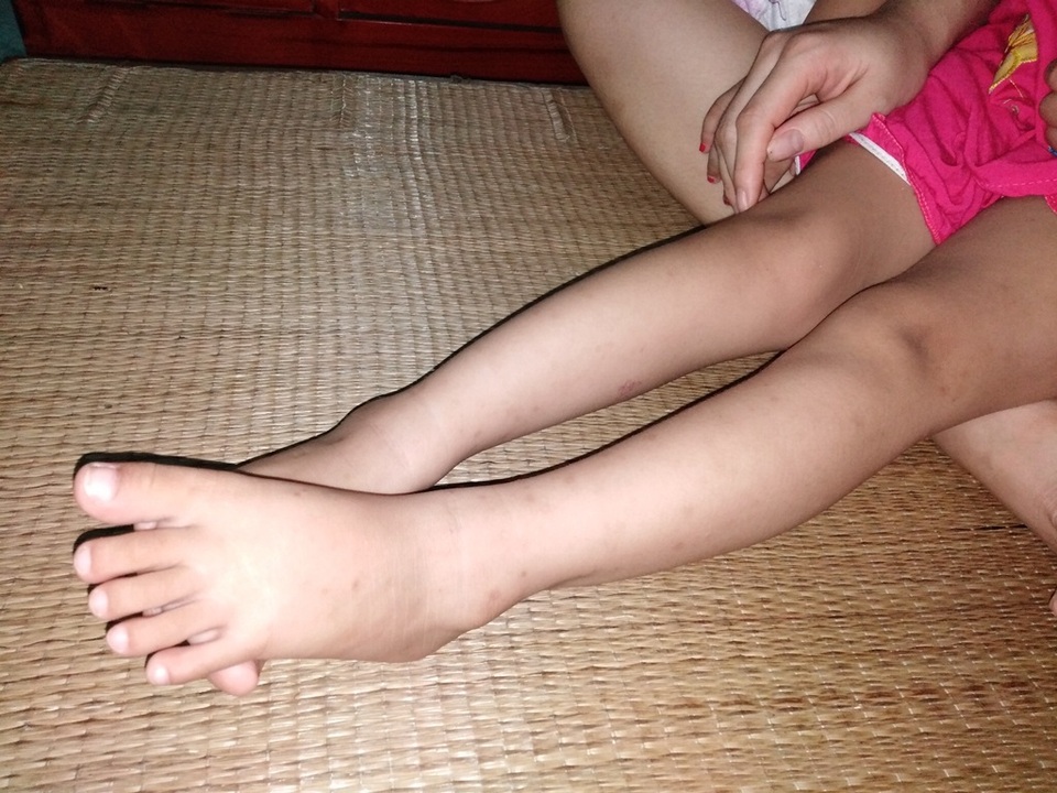 Xót xa bé gái 3 tuổi đã phải chống chọi bệnh ung thư máu - 2 Xót xa bé gái 3 tuổi đã phải chống chọi bệnh ung thư máu - 2