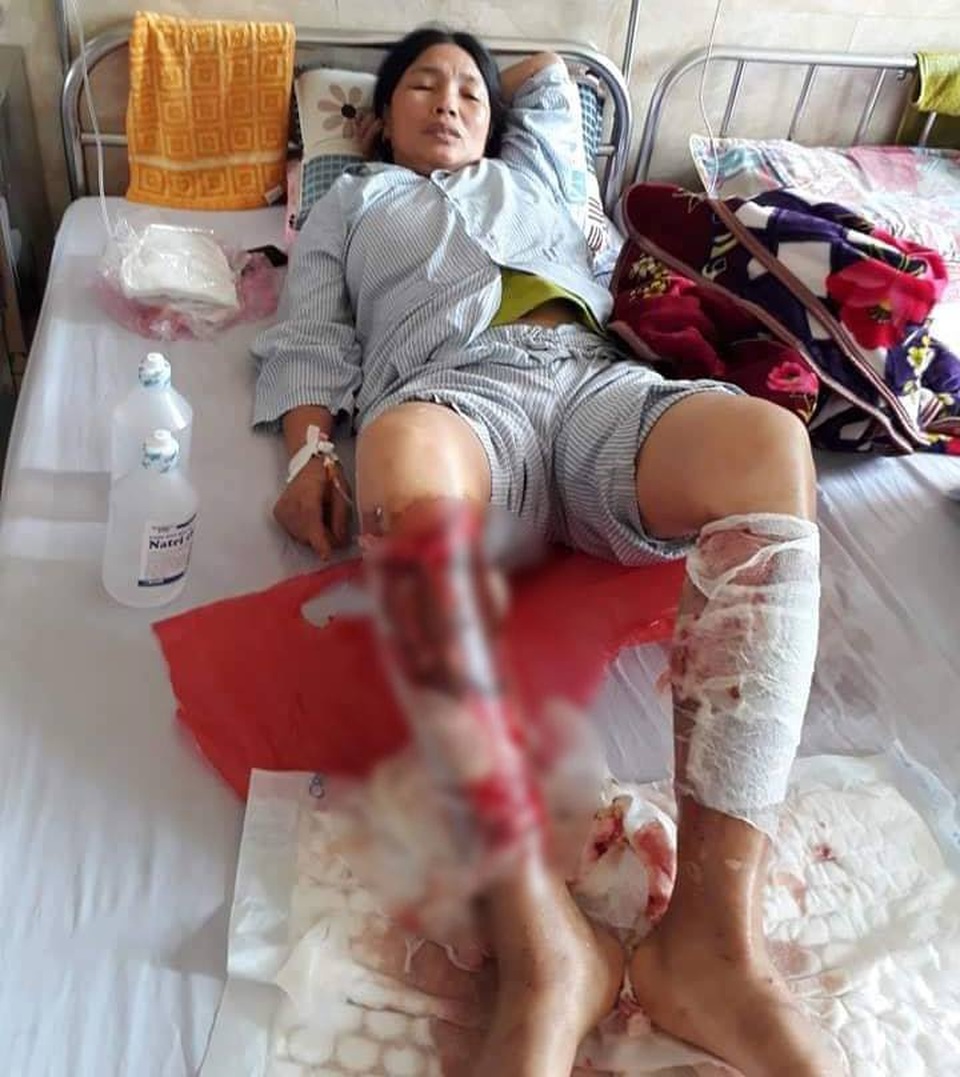 Vụ bỏng nặng khi lội mương: Hơn 6 tỷ đồng khắc phục sự cố chất thải - 2 Vụ bỏng nặng khi lội mương: Hơn 6 tỷ đồng khắc phục sự cố chất thải - 2