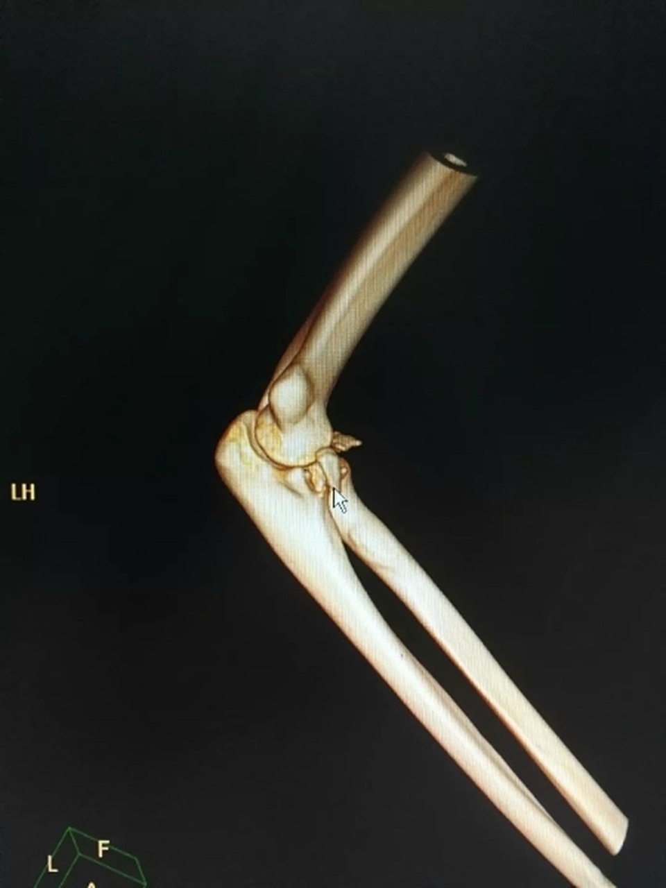 Gãy xương cánh tay, trật khớp khuỷu tay vì bế... bạn gái - 2 Gãy xương cánh tay, trật khớp khuỷu tay vì bế... bạn gái - 2