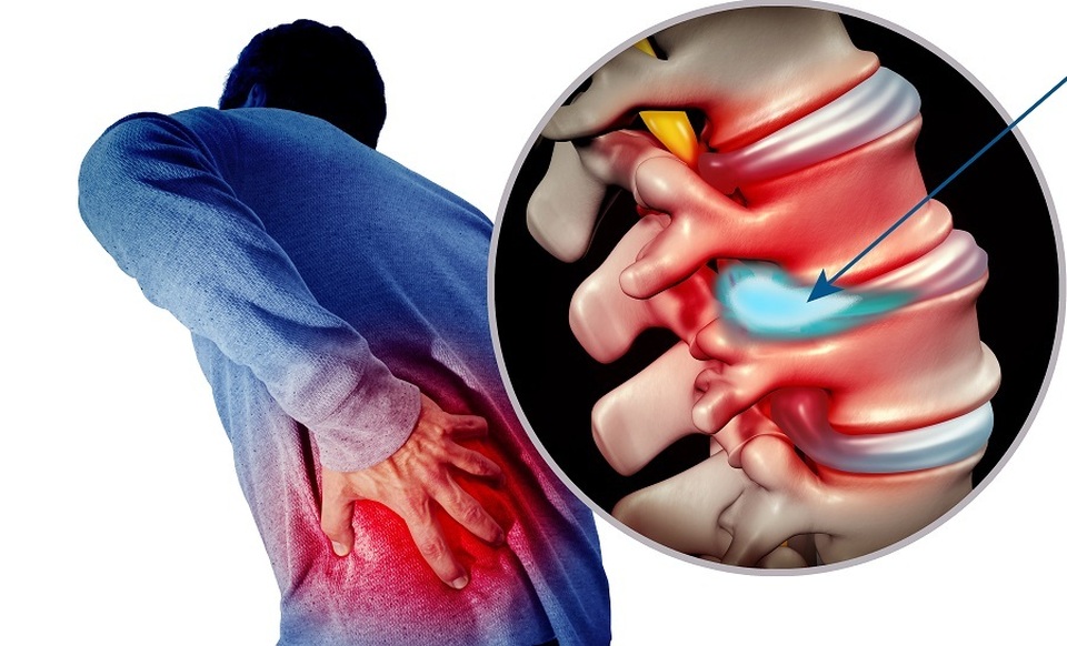 Lạm dụng thuốc giảm đau người thoát vị đĩa đệm dễ tàn phế - 1 Lạm dụng thuốc giảm đau người thoát vị đĩa đệm dễ tàn phế - 1