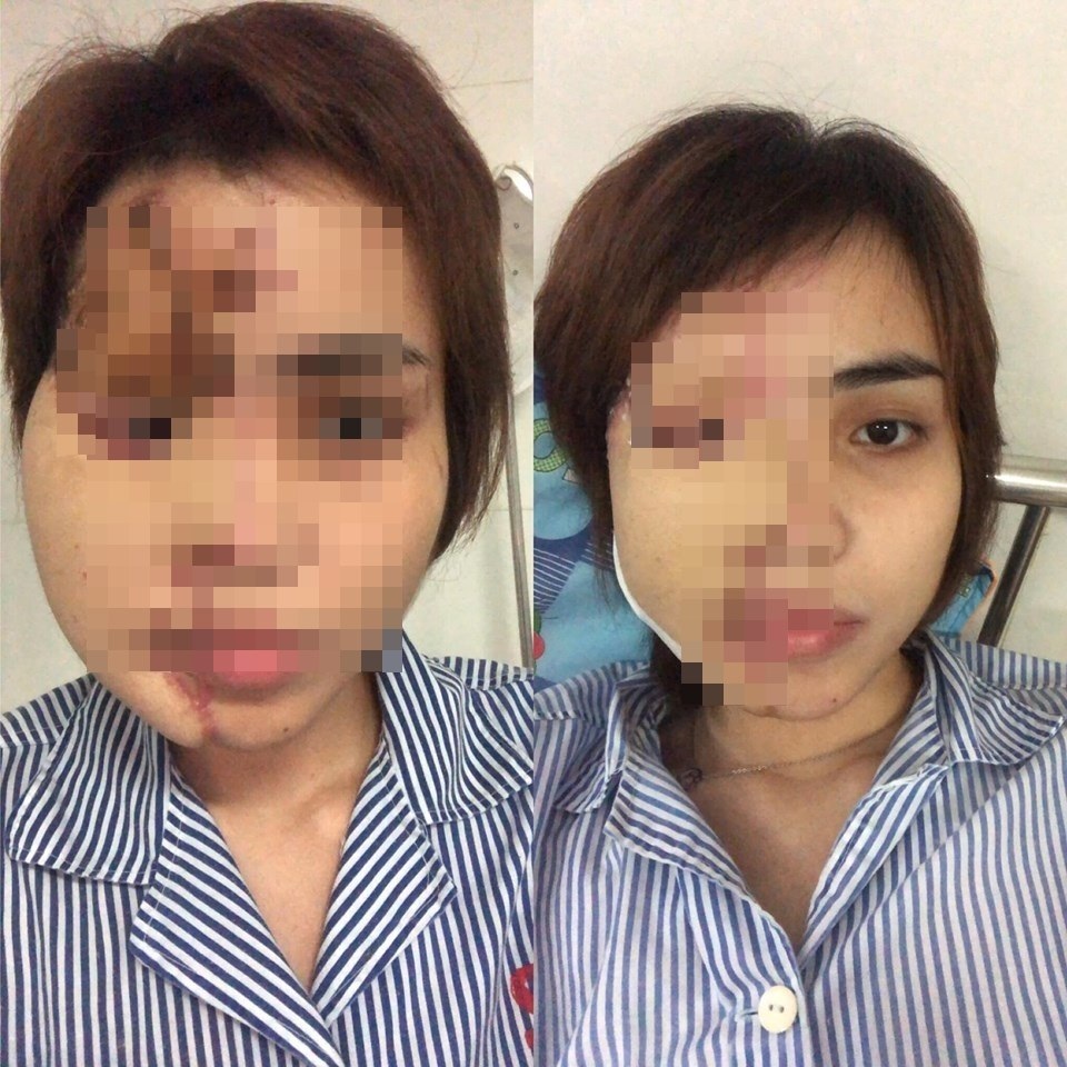 Nỗi đau ám ảnh của cô gái xinh đẹp bị chồng chưa cưới tạt axit - 3 Nỗi đau ám ảnh của cô gái xinh đẹp bị chồng chưa cưới tạt axit - 3