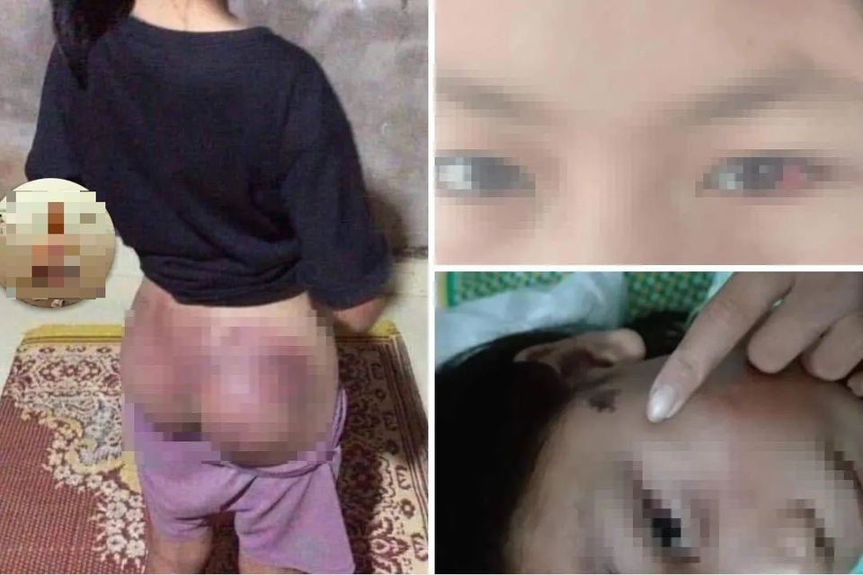 Làm rõ vụ bé gái bị công an đánh bầm tím mông - 1 Làm rõ vụ bé gái bị công an đánh bầm tím mông - 1