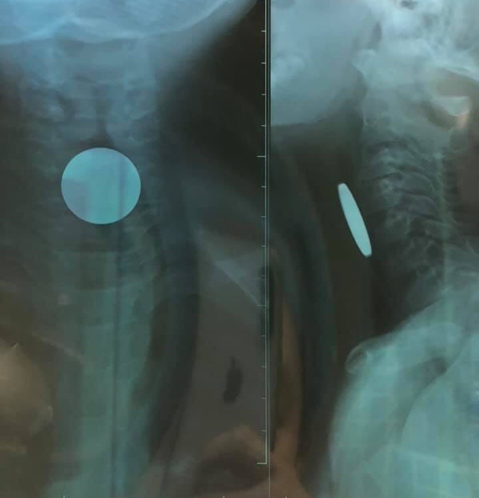 Quảng Bình: Chơi đồng xu, bé trai 5 tuổi nuốt luôn vào thực quản - 1