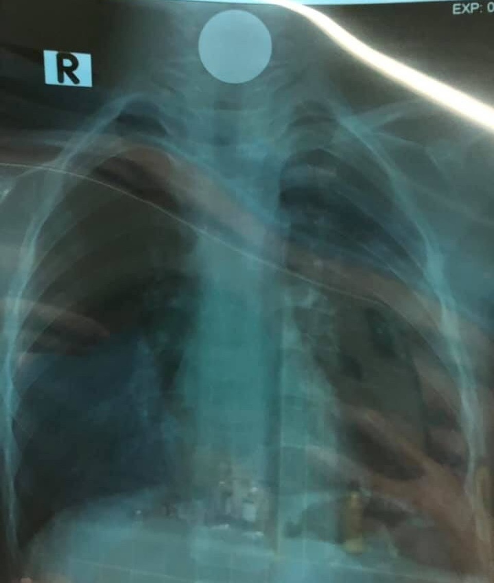 Quảng Bình: Chơi đồng xu, bé trai 5 tuổi nuốt luôn vào thực quản - 2