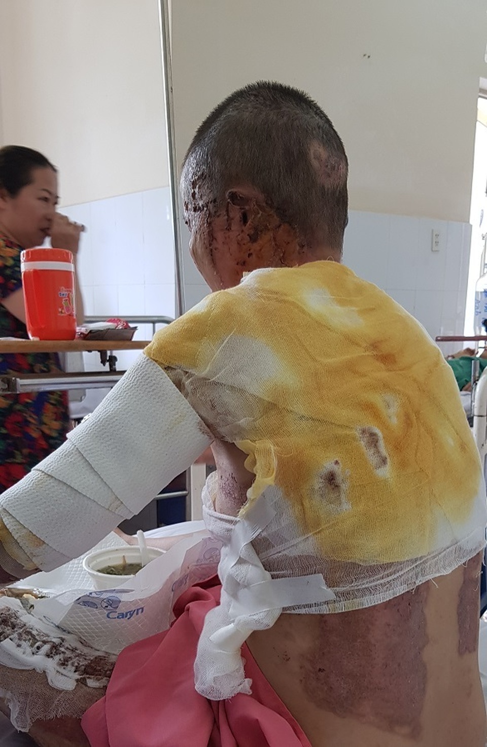 Vợ thành “đuốc sống” vì điếu thuốc lá của chồng - 1