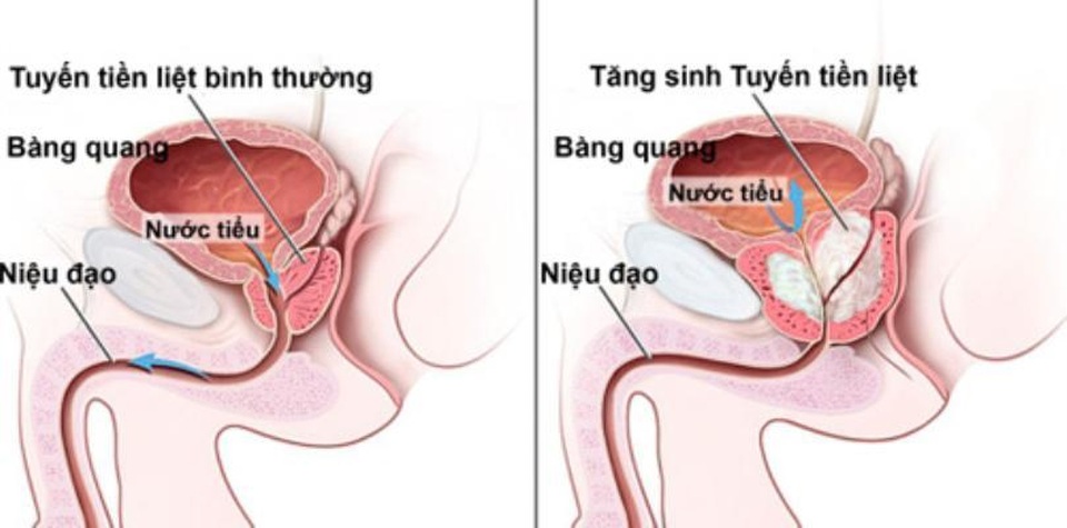 Điểm mấu chốt khi điều trị phì đại tuyến tiền liệt - 2