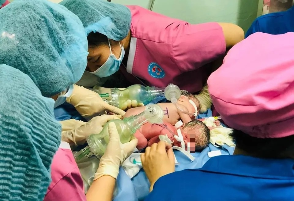 Hai bé gái sơ sinh dính nhau chung một hậu môn - 3 Hai bé gái sơ sinh dính nhau chung một hậu môn - 3