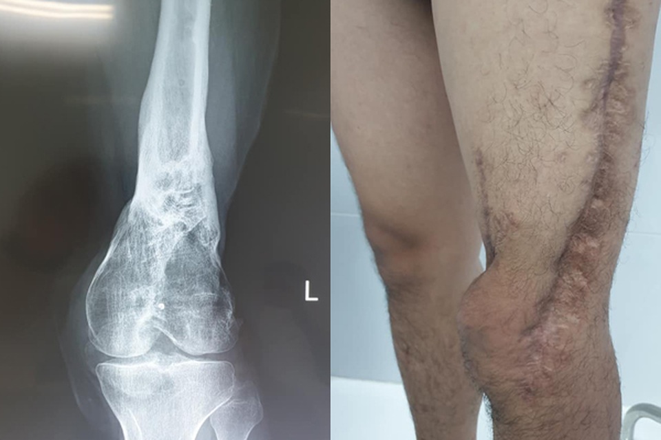 Bác sĩ kể lại hành trình 5 năm cứu chân chàng trai thối mủn lủng lẳng - 1 Bác sĩ kể lại hành trình 5 năm cứu chân chàng trai thối mủn lủng lẳng - 1
