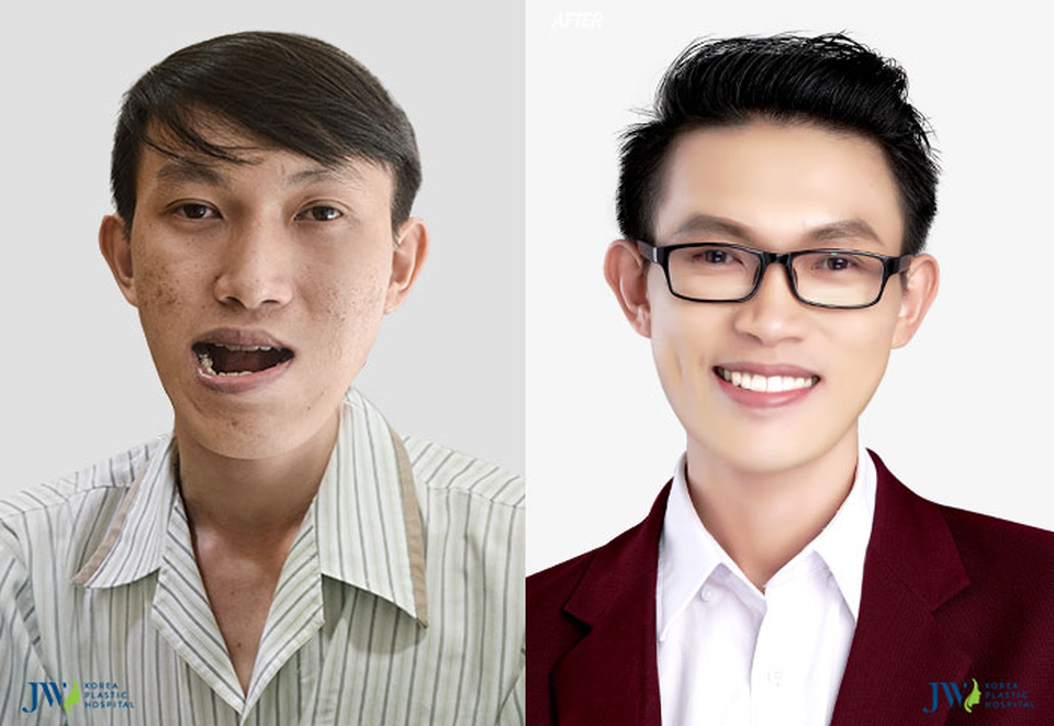 Hỗ trợ phẫu thuật miễn phí cho hàng nghìn trường hợp mắc khuyết điểm - 3
