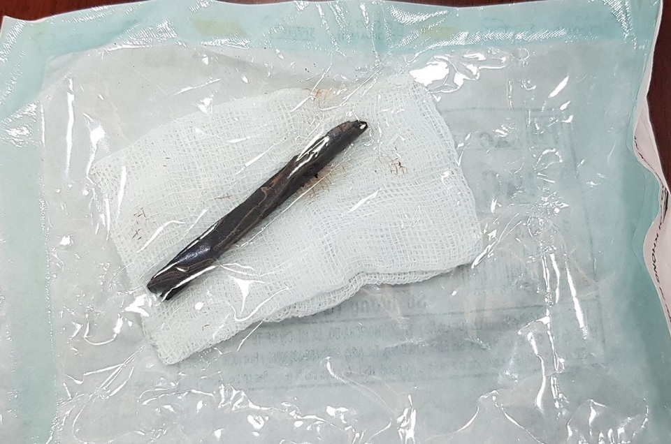 “Bỏ quên” chiếc đũa suốt 4 năm trong hốc mắt - 2 “Bỏ quên” chiếc đũa suốt 4 năm trong hốc mắt - 2