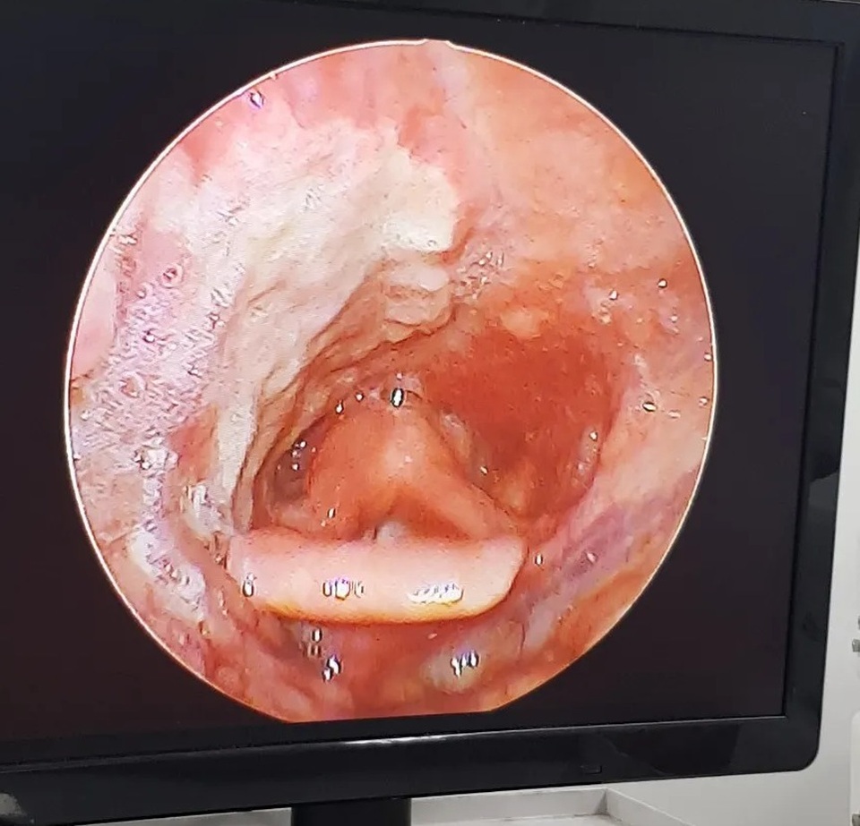 Người phụ nữ mất tới 14kg thịt trong một năm chỉ vì căn bệnh gây nên vết loét hoại tử vùng họng - 1 Người phụ nữ mất tới 14kg thịt trong một năm chỉ vì căn bệnh gây nên vết loét hoại tử vùng họng - 1