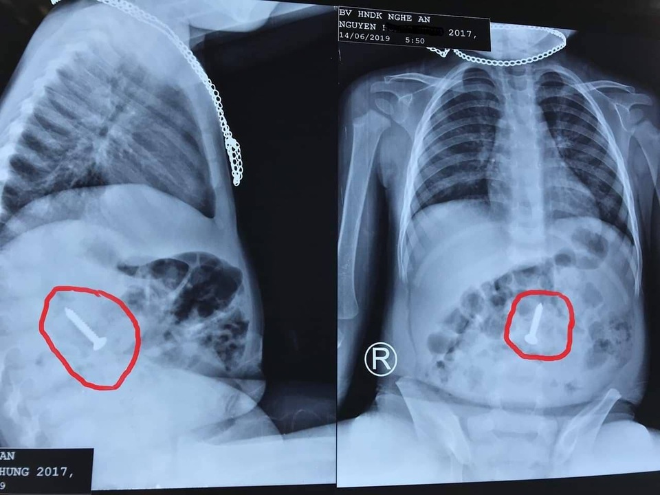 Gắp thành công đinh vít bằng sắt dài 3,5 cm nằm trong tá tràng cháu bé - 2 Gắp thành công đinh vít bằng sắt dài 3,5 cm nằm trong tá tràng cháu bé - 2