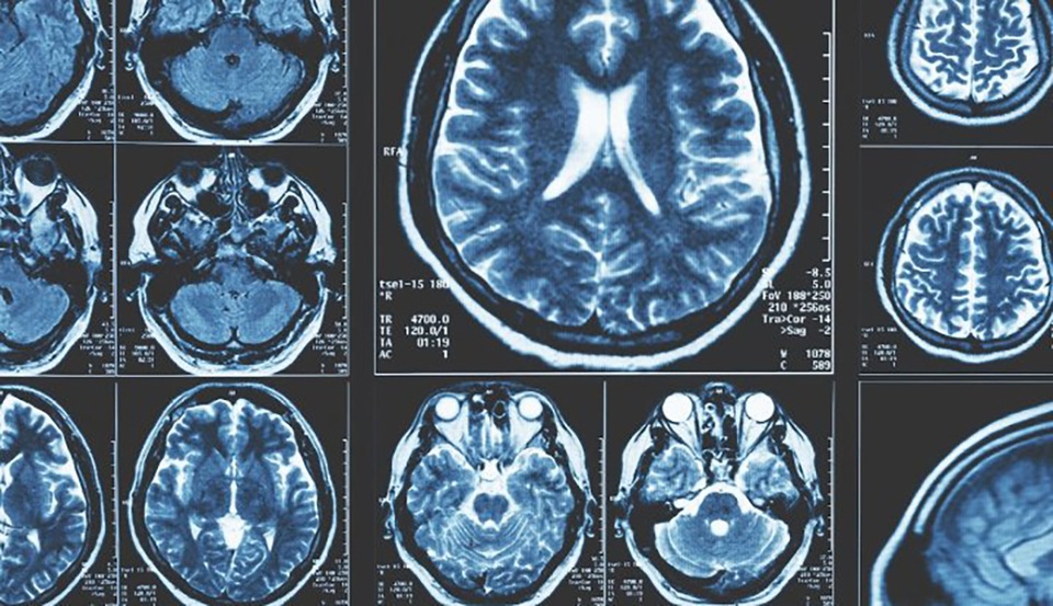 Các nhà nghiên cứu phát hiện ra những dấu hiệu sớm nhất của bệnh Parkinson trong não - 1 Các nhà nghiên cứu phát hiện ra những dấu hiệu sớm nhất của bệnh Parkinson trong não - 1
