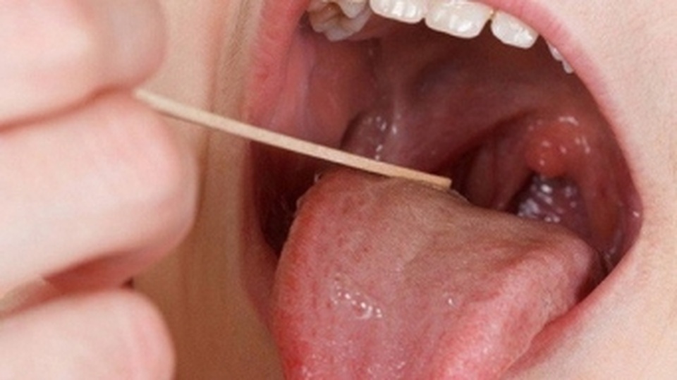 Làm gì để hết nhiệt miệng? - 1 Làm gì để hết nhiệt miệng? - 1
