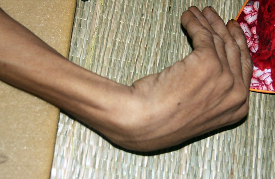 Tận cùng nỗi đau của người đàn ông đơn độc bị bệnh tật đọa đày gầy trơ xương - 4 Tận cùng nỗi đau của người đàn ông đơn độc bị bệnh tật đọa đày gầy trơ xương - 4