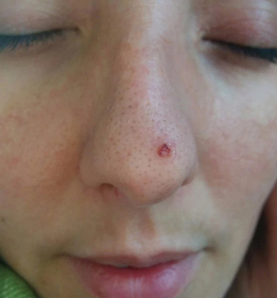 Làm đẹp không phòng bị cẩn thận, cô gái phải cắt bỏ một phần mũi - 1