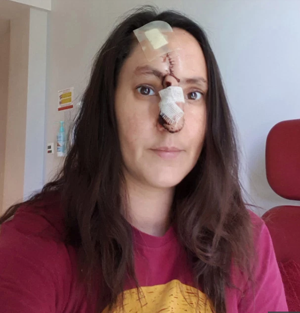 Làm đẹp không phòng bị cẩn thận, cô gái phải cắt bỏ một phần mũi - 2