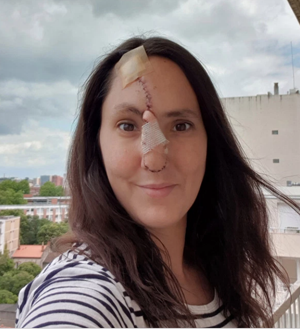 Làm đẹp không phòng bị cẩn thận, cô gái phải cắt bỏ một phần mũi - 3