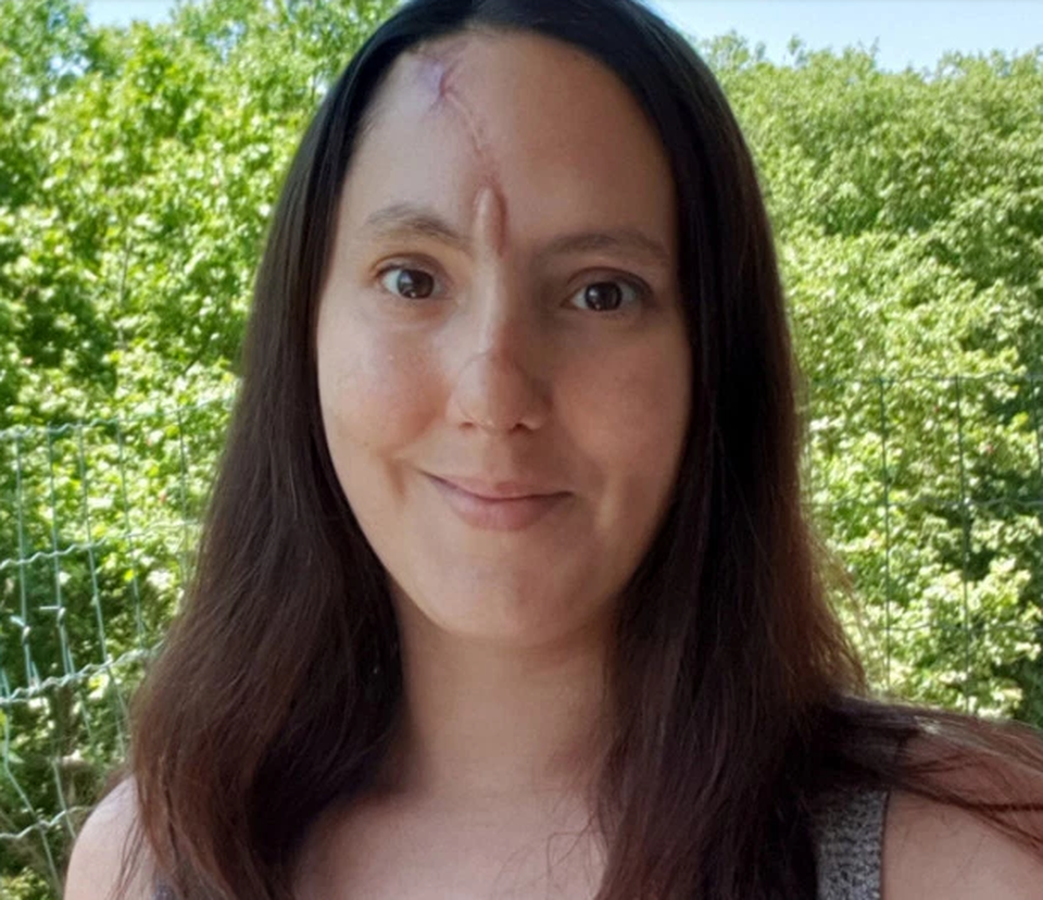 Làm đẹp không phòng bị cẩn thận, cô gái phải cắt bỏ một phần mũi - 5