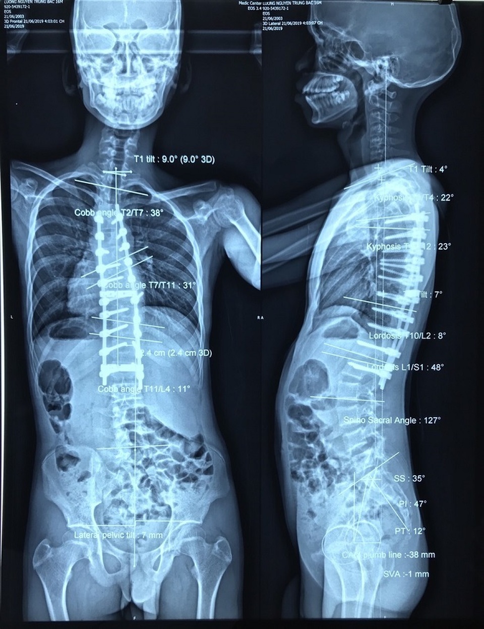 Nam thanh niên có cột sống uốn lượn như… xương rắn - 3