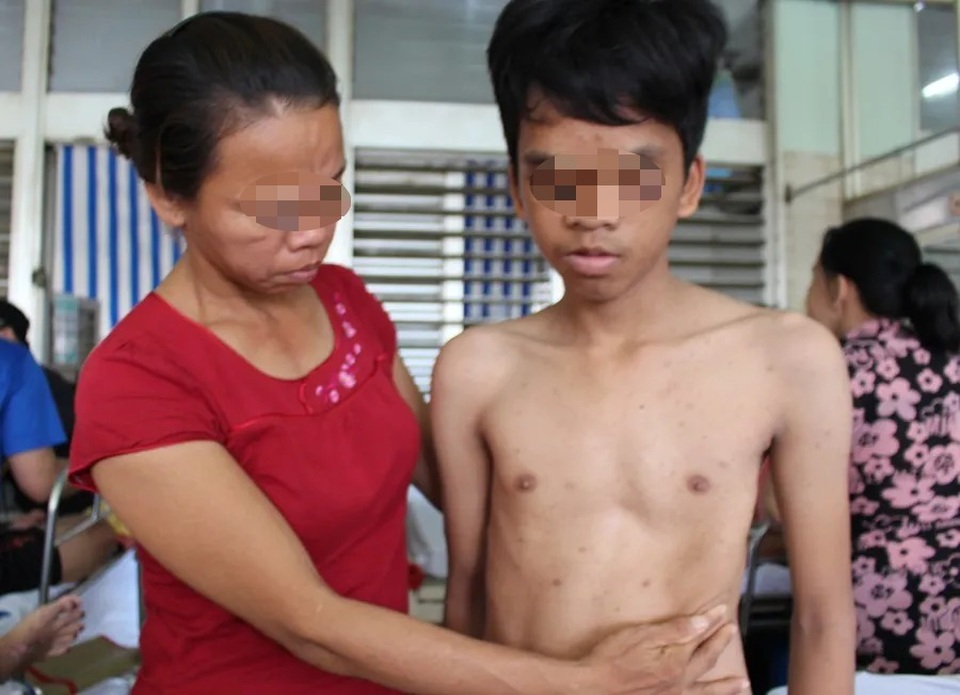 Nam thanh niên có cột sống uốn lượn như… xương rắn - 1