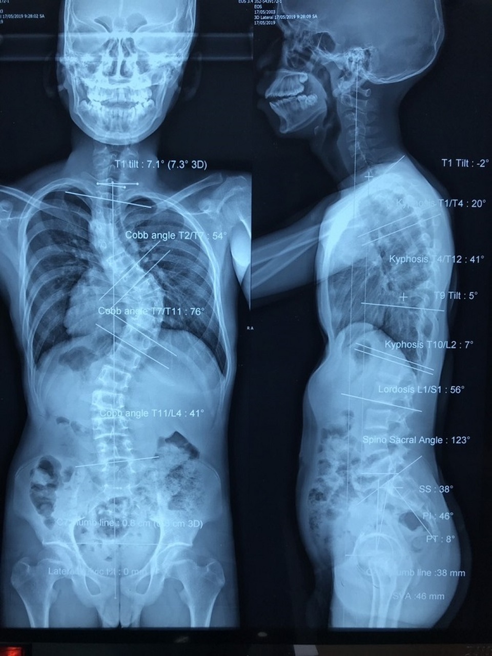 Nam thanh niên có cột sống uốn lượn như… xương rắn - 2