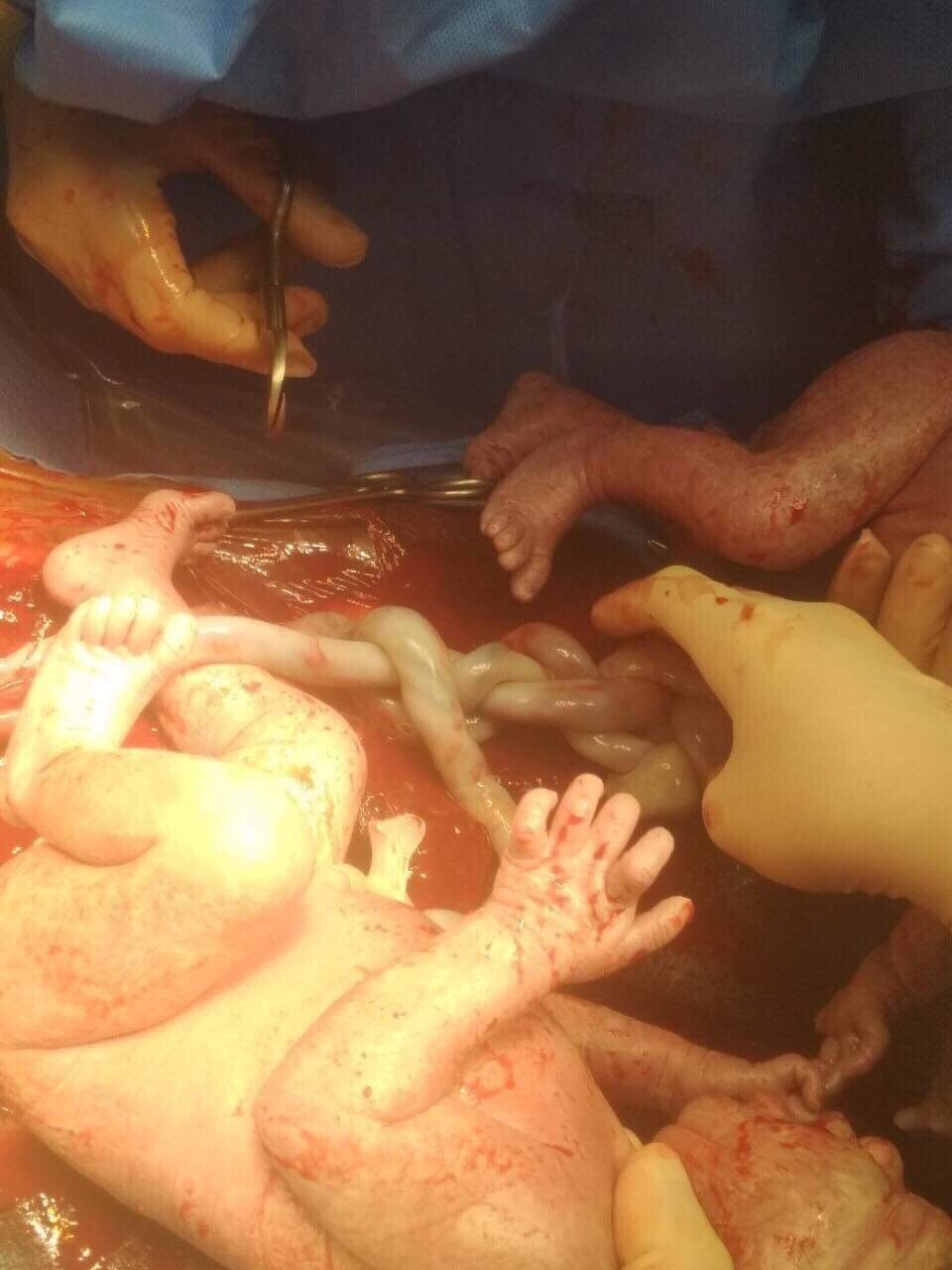 Nghẹt thở ca mổ bắt con “độc nhất vô nhị” trong ngành sản khoa - 2 Nghẹt thở ca mổ bắt con “độc nhất vô nhị” trong ngành sản khoa - 2