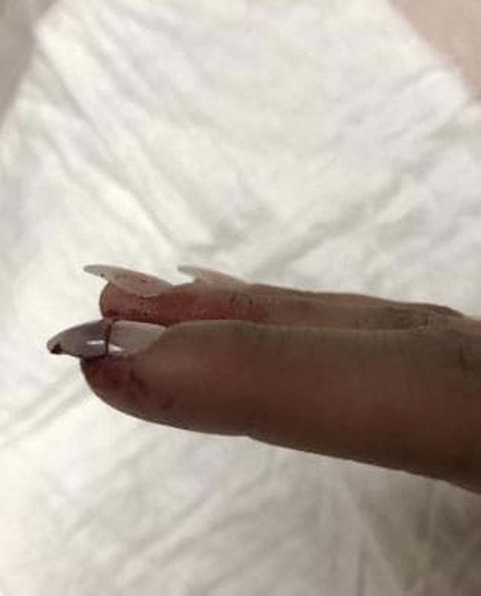 Nữ du khách mất 41 triệu đồng vì móng tay bị gãy ở Mỹ - 2