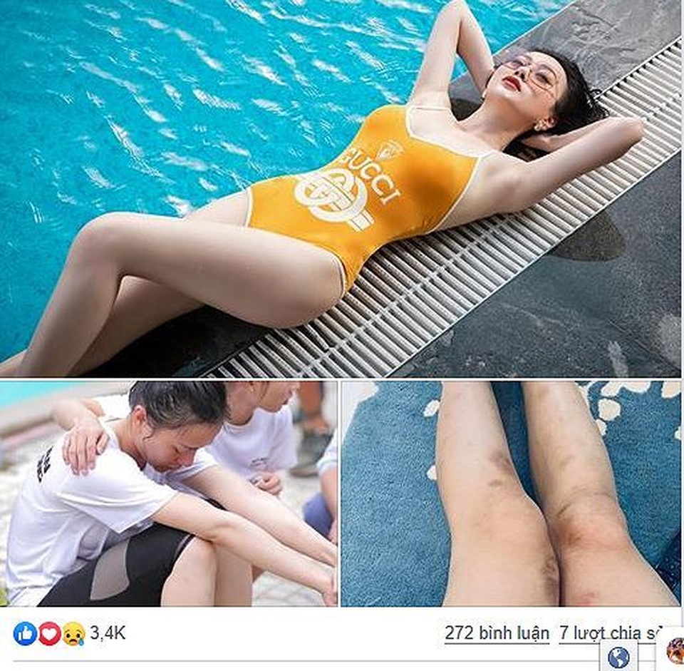 “Quỳnh búp bê” xuất hiện với đôi chân bầm dập sau nửa tháng “mất tích” - 1 “Quỳnh búp bê” xuất hiện với đôi chân bầm dập sau nửa tháng “mất tích” - 1