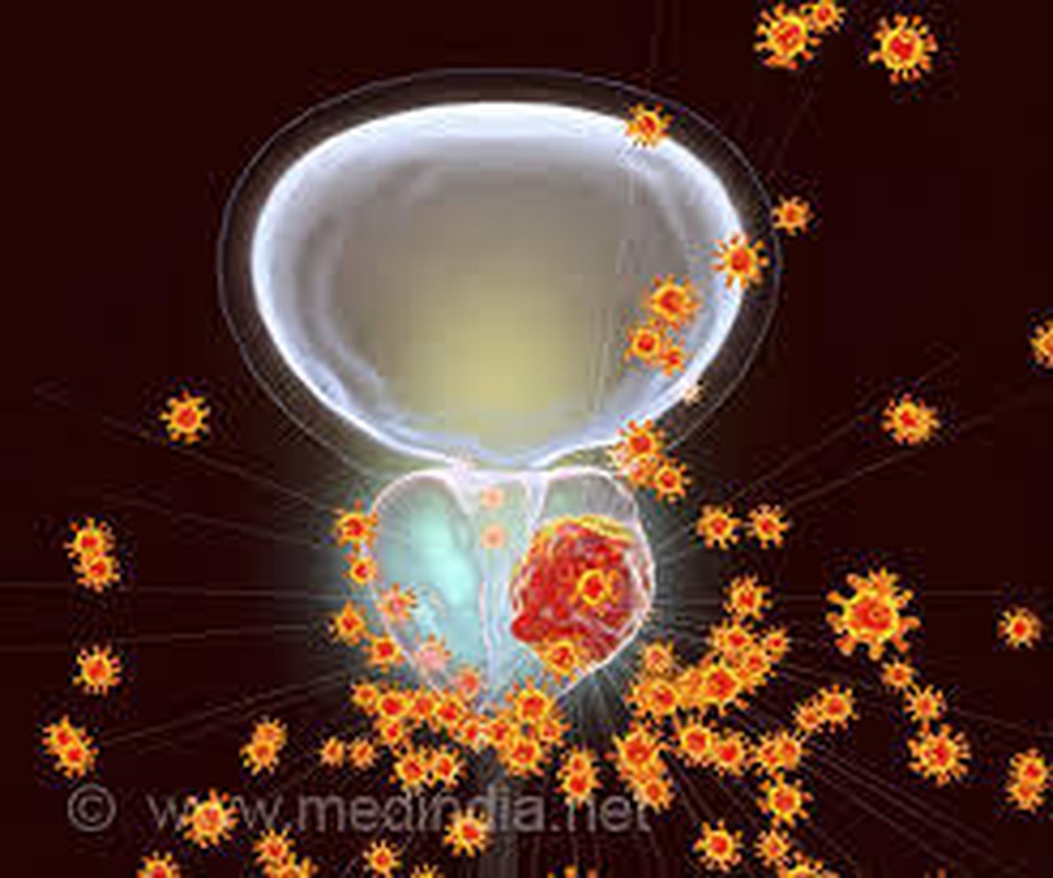 PUR: Test quý để lượng giá mức độ ung thư tiền liệt - 1 PUR: Test quý để lượng giá mức độ ung thư tiền liệt - 1