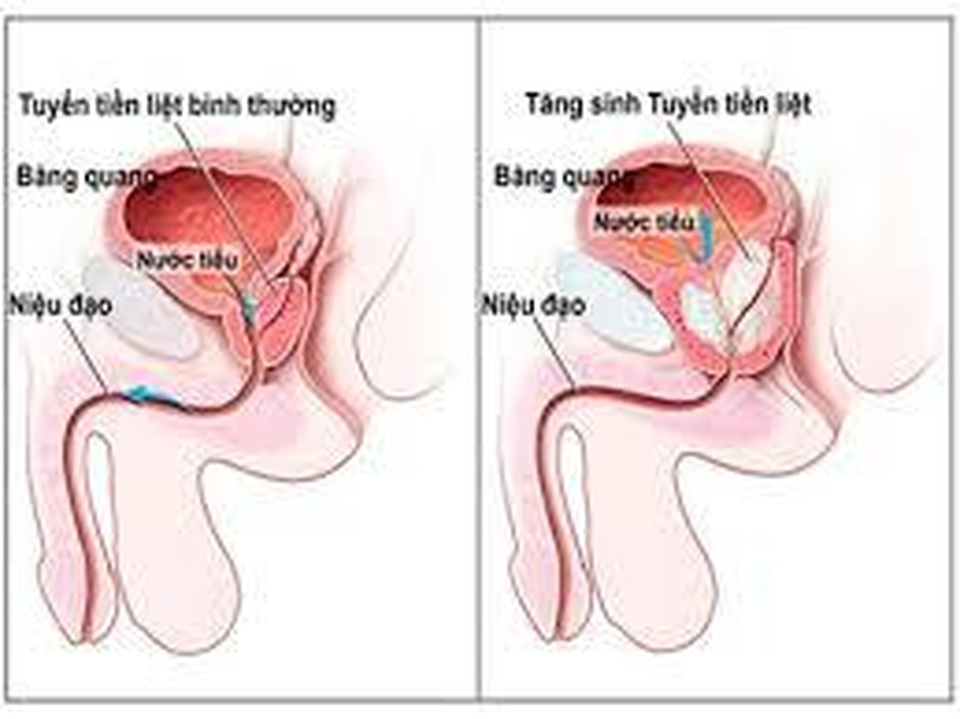 PUR: Test quý để lượng giá mức độ ung thư tiền liệt - 2 PUR: Test quý để lượng giá mức độ ung thư tiền liệt - 2
