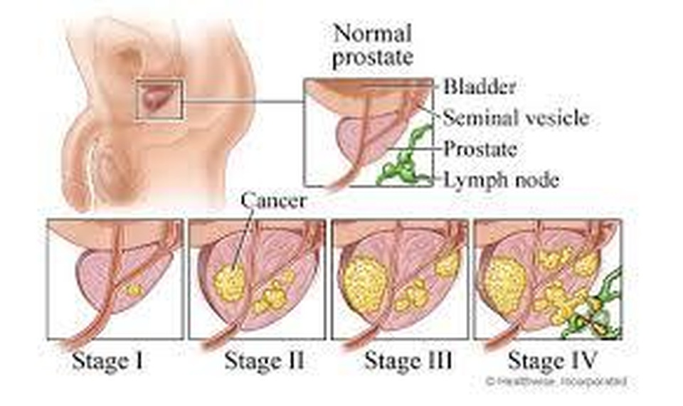 PUR: Test quý để lượng giá mức độ ung thư tiền liệt - 4 PUR: Test quý để lượng giá mức độ ung thư tiền liệt - 4
