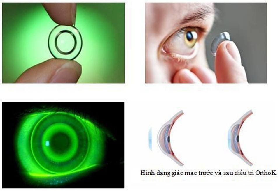 Điều chỉnh cận loạn thị không phẫu thuật bằng phương pháp Ortho K - 2 Điều chỉnh cận loạn thị không phẫu thuật bằng phương pháp Ortho K - 2