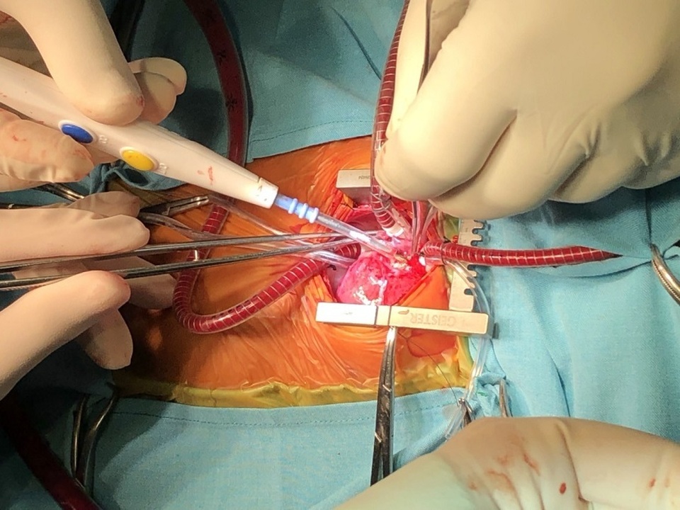 Trái tim lớn hơn ngón tay cái hồi sinh sau 2 lần phẫu thuật - 5