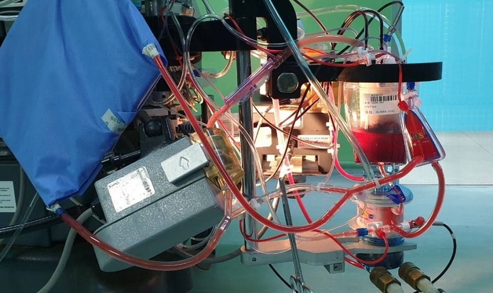 Trái tim lớn hơn ngón tay cái hồi sinh sau 2 lần phẫu thuật - 3