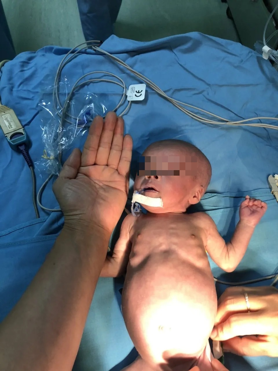 Trái tim lớn hơn ngón tay cái hồi sinh sau 2 lần phẫu thuật - 2