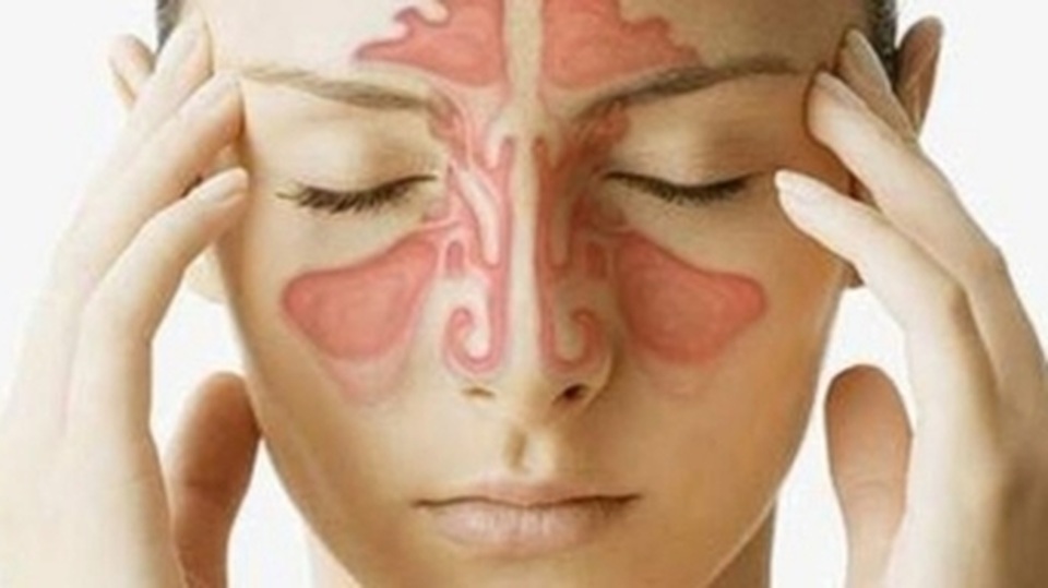 Có thuốc trị dứt điểm bệnh viêm xoang? - 1