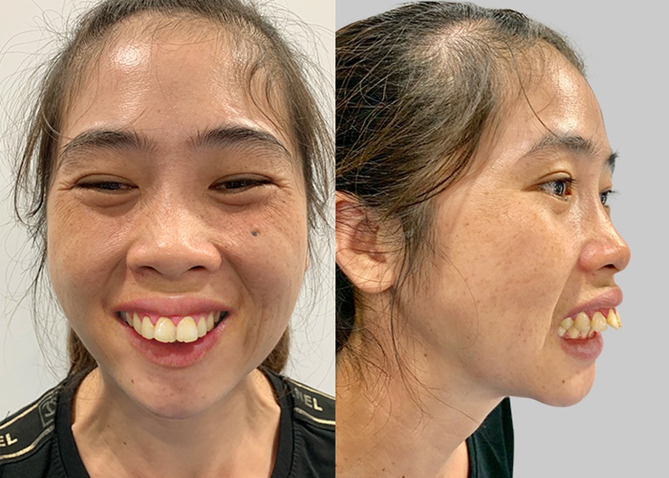 Rơi nước mắt với câu chuyện ngặt nghèo của nữ công nhân khiếm khuyết ngoại hình - 3 Rơi nước mắt với câu chuyện ngặt nghèo của nữ công nhân khiếm khuyết ngoại hình - 3