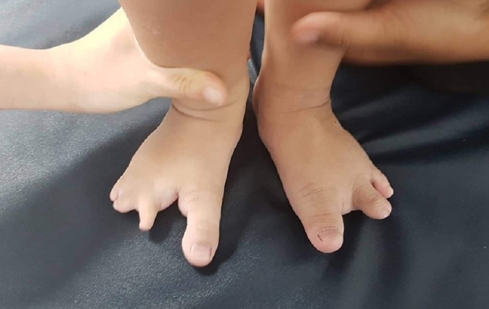 Bé trai có bàn tay, bàn chân như càng tôm hùm - 2 Bé trai có bàn tay, bàn chân như càng tôm hùm - 2