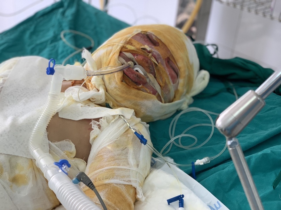 Đớn đau thảm cảnh gia đình 4 người bị thiêu sống: Hãy cứu tính mạng 2 bà cháu - 2 Đớn đau thảm cảnh gia đình 4 người bị thiêu sống: Hãy cứu tính mạng 2 bà cháu - 2