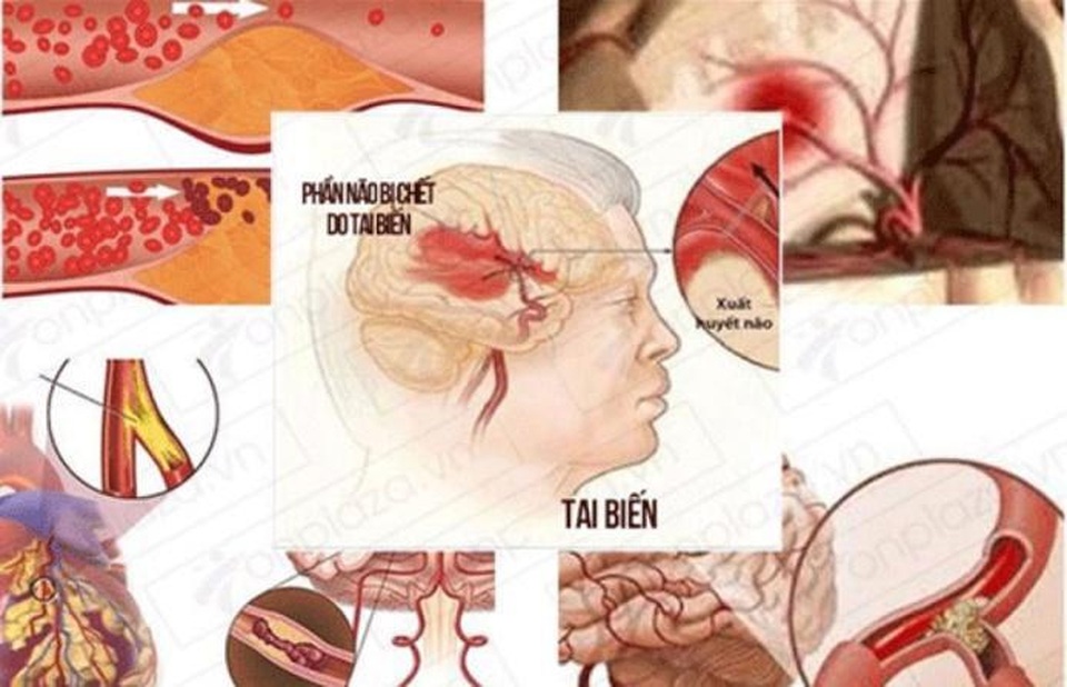 Nattospes hỗ trợ cải thiện di chứng tai biến mạch máu não như thế nào? - 1