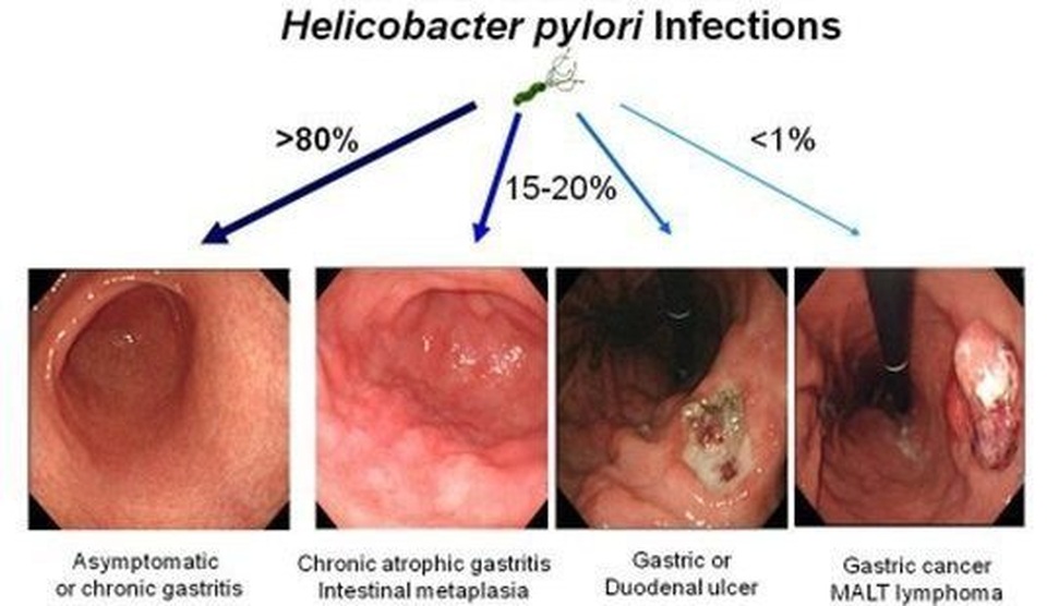 Vi khuẩn HP có gene Cag A sẽ gây ung thư dạ dày? - 2