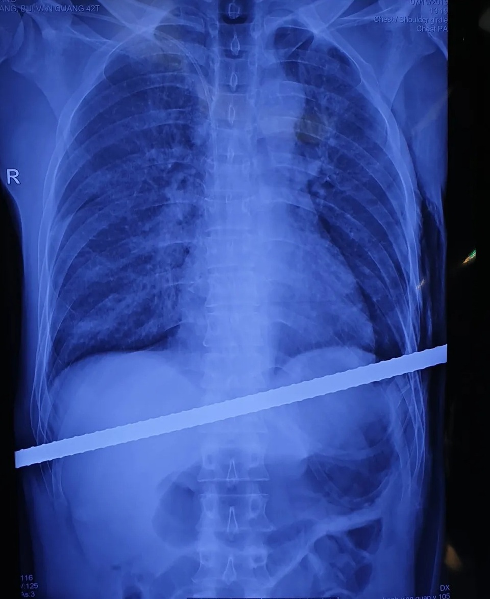 Kỳ tích cứu sống người đàn ông bị thanh sắt đâm xuyên người - 1