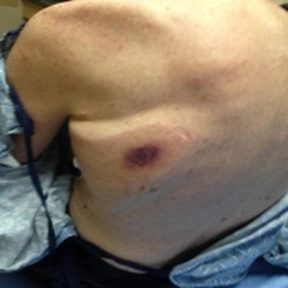 Du khách tử vong vì nhiễm vi khuẩn ăn thịt người sau khi tắm biển - 1