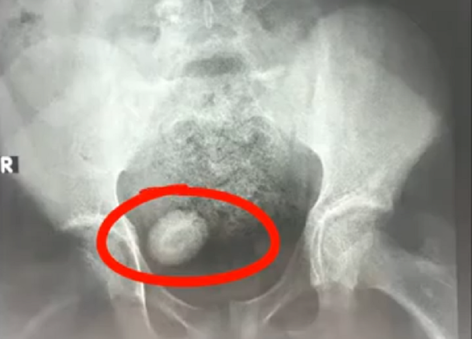 Viên sỏi như quả trứng gà trong bàng quang cậu bé 13 tuổi - 1