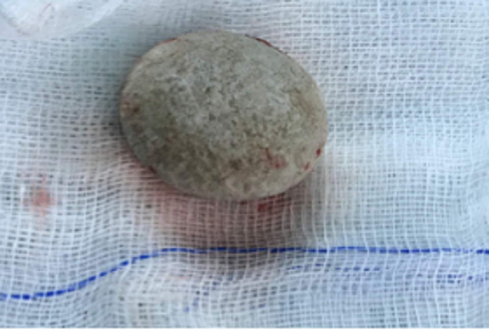 Viên sỏi như quả trứng gà trong bàng quang cậu bé 13 tuổi - 3